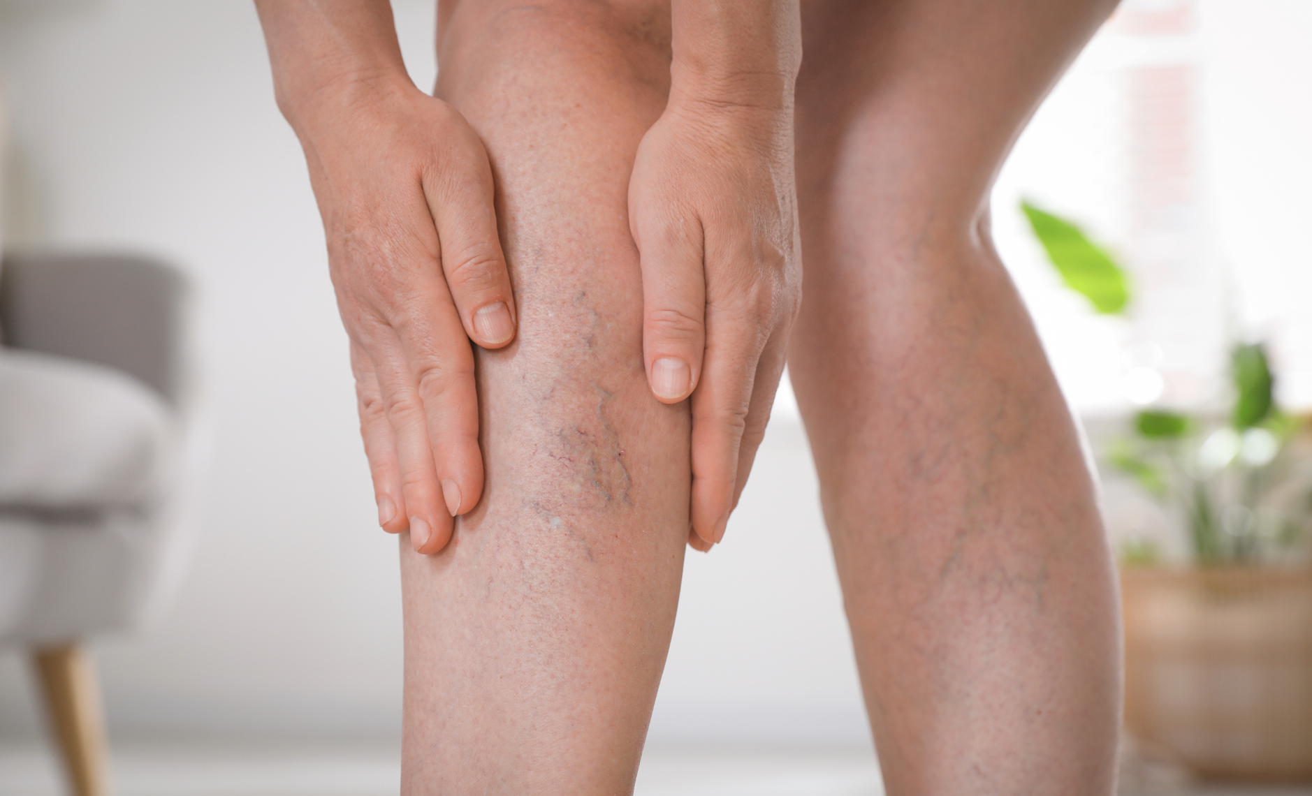 Заболевания вен: причины, первые симптомы и профилактика